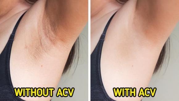 How to reduce dark underarms to confidently go to the beach in the summer-1