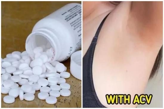 Cách giảm mờ vùng thâm dưới cánh tay để tự tin đi biển mùa hè