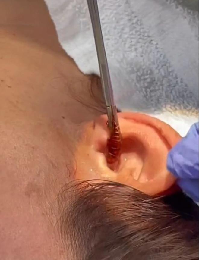 Đang ngủ bỗng thấy đau tai, cô gái kinh hãi khi thấy vật lạ lòi ra-2