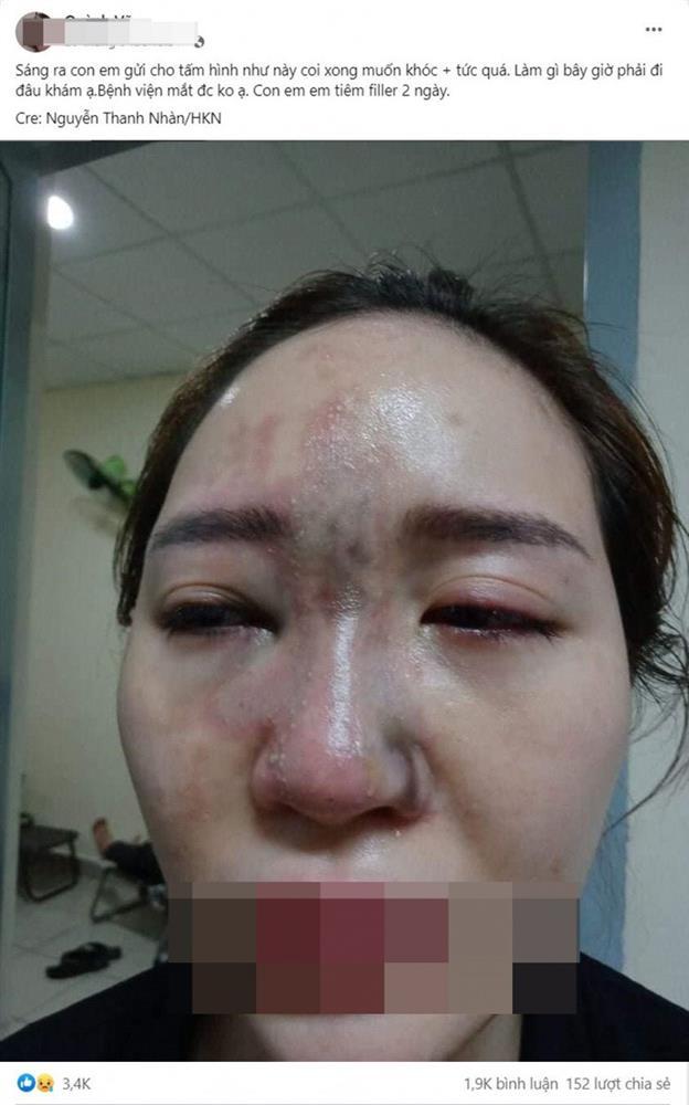 Cô gái tím đen hết mặt vì tiêm filler nâng mũi-1