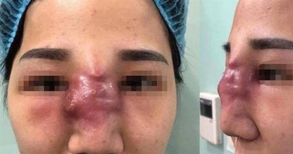 Cô gái tím đen hết mặt vì tiêm filler nâng mũi-4