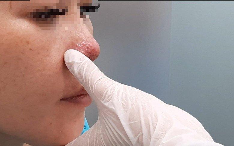Cô gái tím đen hết mặt vì tiêm filler nâng mũi-5