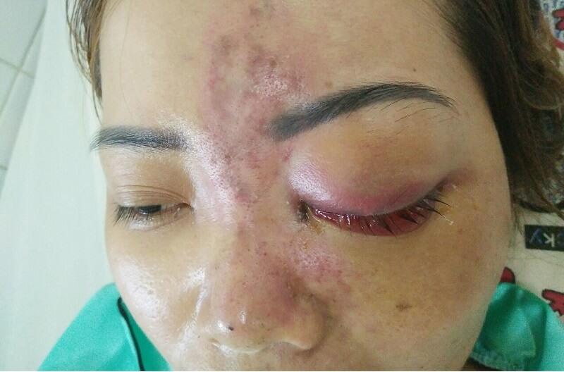 Cô gái tím đen hết mặt vì tiêm filler nâng mũi-8