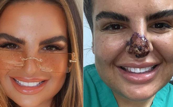 Cô gái tím đen hết mặt vì tiêm filler nâng mũi-9