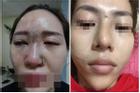 Cô gái tím đen hết mặt vì tiêm filler nâng mũi