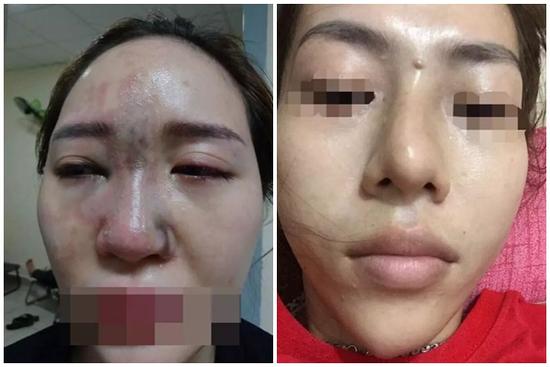 Cô gái tím đen hết mặt vì tiêm filler nâng mũi