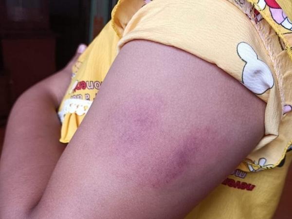 Giáo viên đánh tím tay học sinh lớp 1 vì không làm xong bài kiểm tra-1