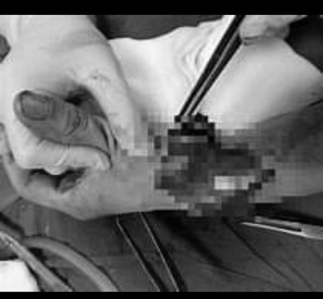 Đang nằm ngủ, người đàn ông bị chém vào đầu, gần đứt lìa ngón tay-1