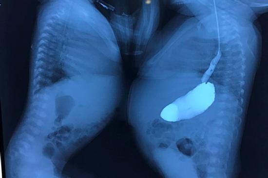 Cặp song sinh dính liền hiếm gặp, 200.000 trẻ mới gặp 1 ca