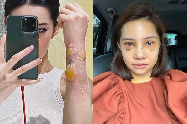 Hồng Ngọc tự tin đọ sắc Hương Giang sau 2 năm bỏng kinh hoàng-6