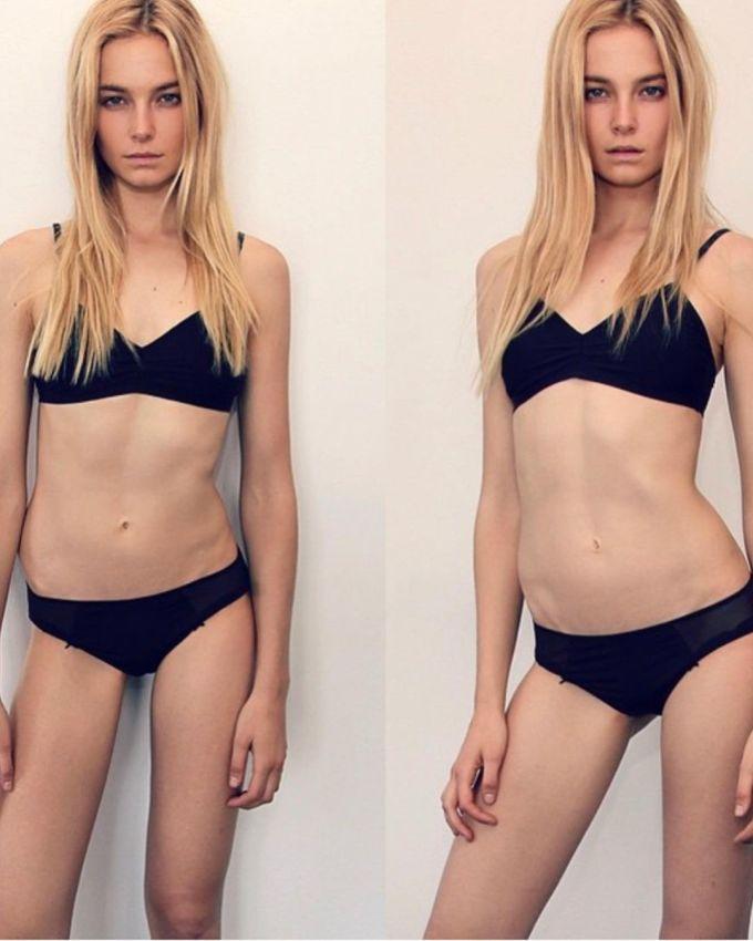 Cựu mẫu nội y hồi phục sau 4 năm mắc chứng biếng ăn-3