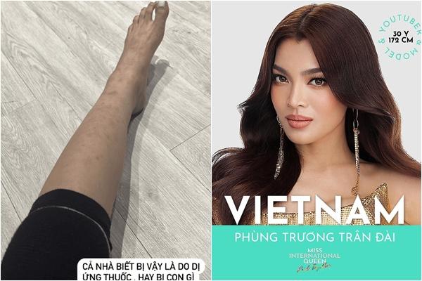 Tran Dai’s legs are broken near the day of Miss International Queen contest