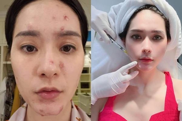 Doan Di Bang’s face full of acne scars