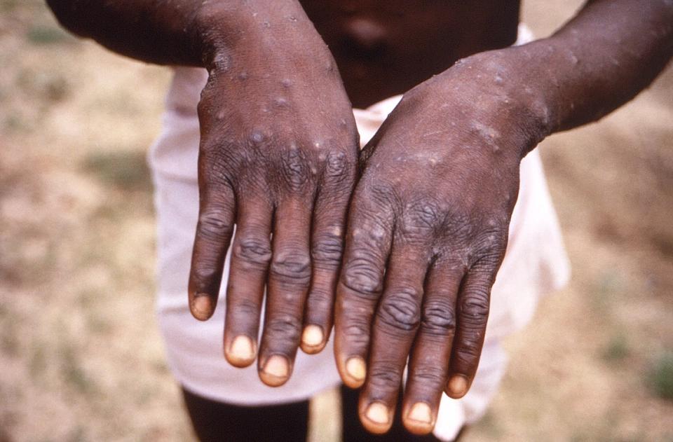 WHO: Clinical manifestations of monkeypox have changed-2