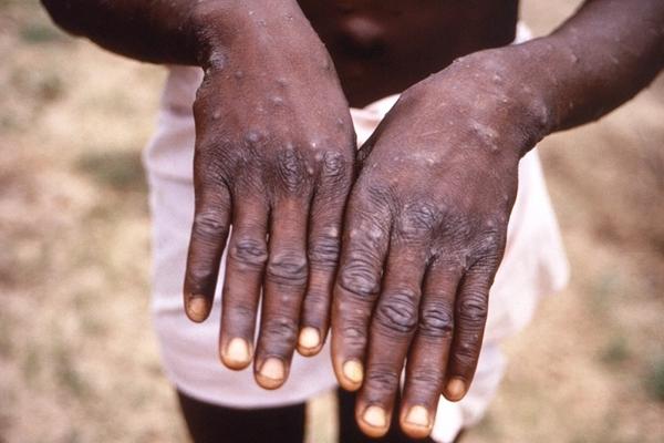Clinical manifestations of monkeypox have changed
