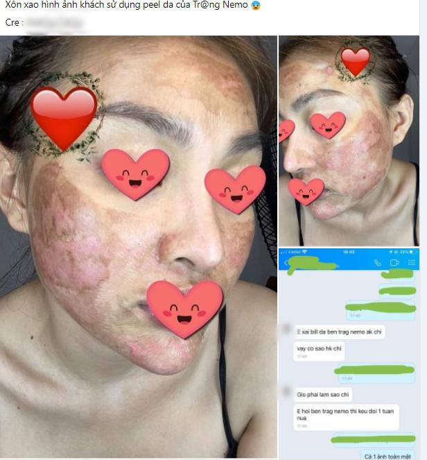 Cô gái như bỏng nặng khi dùng sản phẩm giống Trang Nemo-1