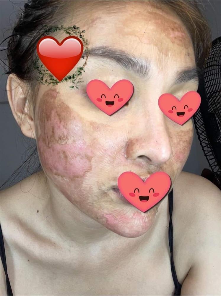 Cô gái như bỏng nặng khi dùng sản phẩm giống Trang Nemo-3