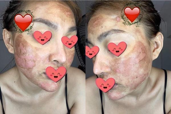 Stirring up the girl with severe burns after using Trang Nemo’s skin peeling products