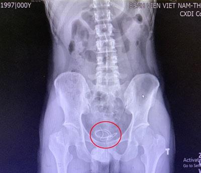 Thanh niên nhét dây tai nghe vào niệu đạo tự sướng, hối không kịp-1