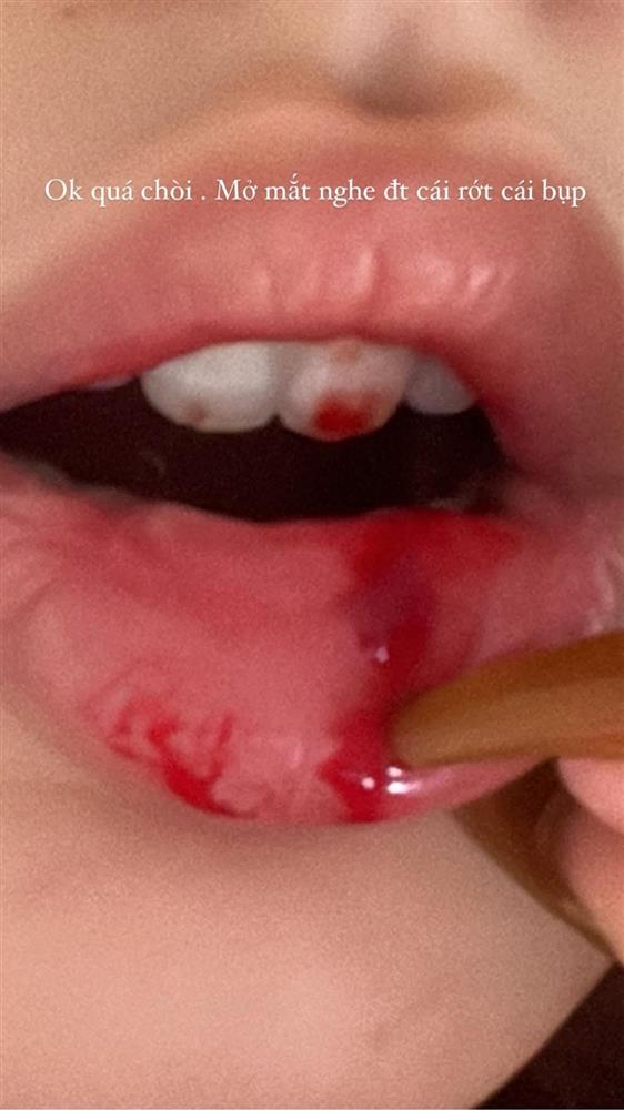 Xoài Non lộ ảnh máu me quanh miệng, như bị đi đường quyền-1