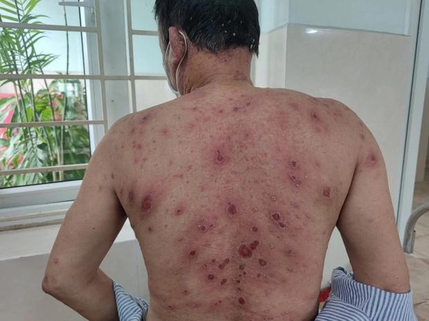 Tin quảng cáo thuốc nam sạch, bệnh nhân bị phát vảy nến toàn thân-1