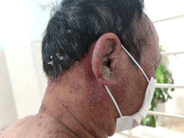 Tin quảng cáo thuốc nam sạch, bệnh nhân bị phát vảy nến toàn thân-2