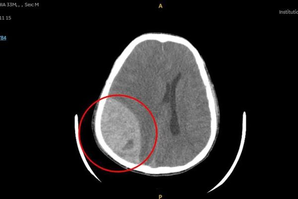 Hy hữu: Người đàn ông bị xuất huyết não sau khi đi bơi-2