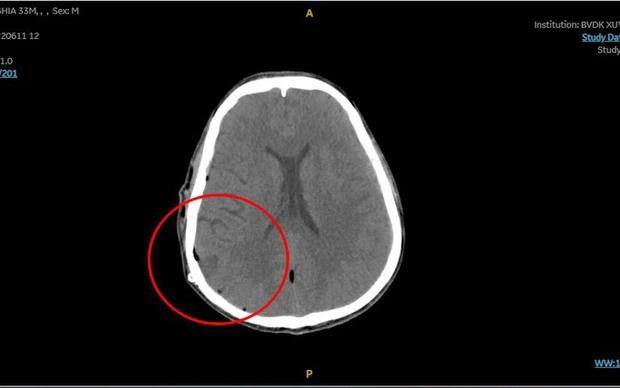 Hy hữu: Người đàn ông bị xuất huyết não sau khi đi bơi-1