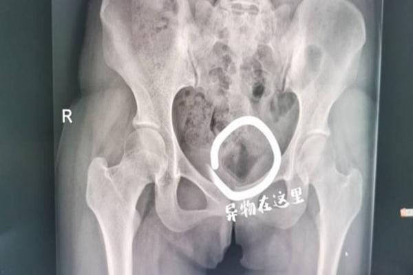 Mây mưa tìm cảm giác lạ, bạn trai gây tai nạn cho bạn gái vì dị vật lạ-1