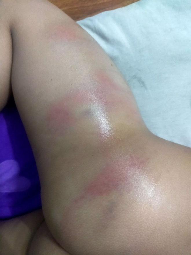 Bé gái 4 tuổi nghi bị cô giáo đánh bầm tím vì đi vệ sinh ra quần-1
