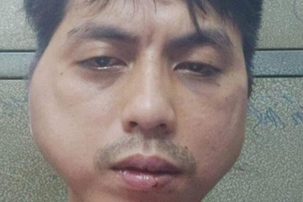 Thanh niên bị chủ quán lẩu nướng đánh đập biến dạng khuôn mặt-1