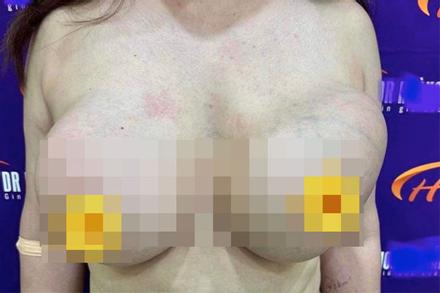 Ôm ngực khổng lồ muốn 'nổ tung' về nước, nữ Việt Kiều cầu cứu bác sĩ