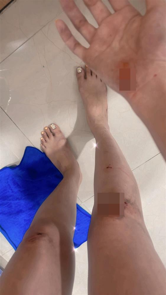 Hoa hậu Diễm Hương gặp chấn thương giữa lùm xùm đời tư-3