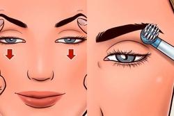 Cách chữa sụp mí mắt đơn giản tại nhà