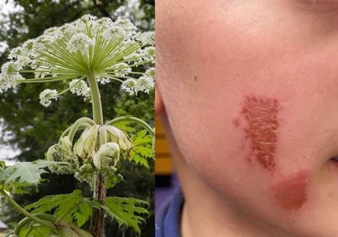 Cây sứ giả địa ngục khiến bé trai bỏng mặt chỉ sau cú chạm nhẹ-1