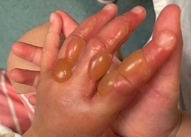 Cây sứ giả địa ngục khiến bé trai bỏng mặt chỉ sau cú chạm nhẹ-3