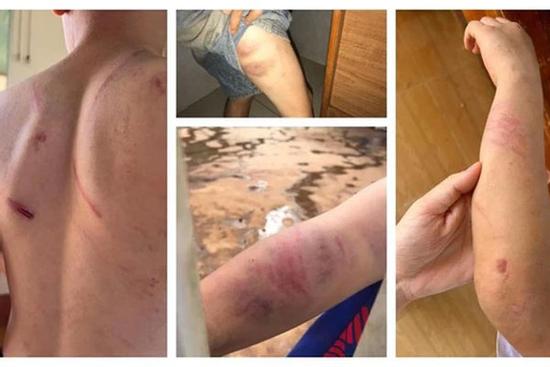 Vụ cháu bé 9 tuổi bị bà và cha đánh đập dã man: Bố mẹ bé nói gì?