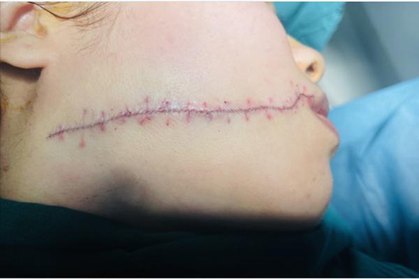 Cãi nhau, chồng dùng dao lam rạch mặt vợ-1