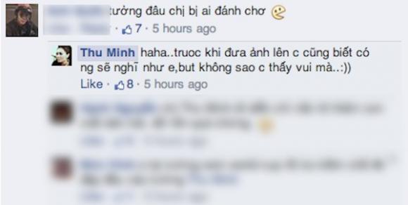 Chuyện gì đây, Thu Minh xuất hiện với cơ thể bầm dập?-16