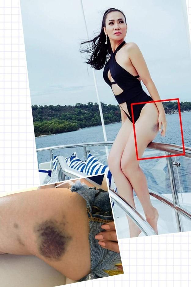 Chuyện gì đây, Thu Minh xuất hiện với cơ thể bầm dập?-12