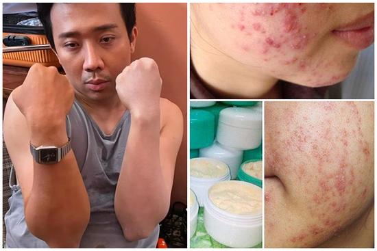 Trấn Thành gặp 'nạn' vì bôi kem trộn