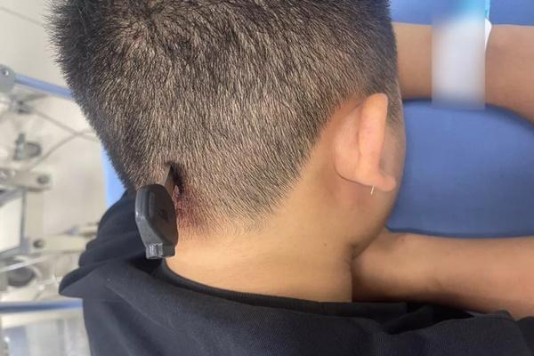 Cấp cứu kịp thời cháu bé 12 tháng tuổi bị đinh cắm vào đầu-4