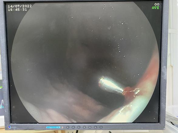 Nuốt mảnh thủy tinh biểu diễn, thanh niên bị rách dạ dày, máu chảy thành vòi-2