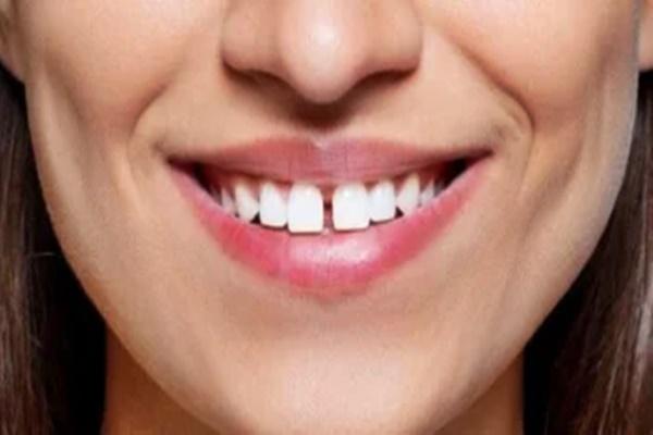 Tỷ phú răng thưa có những đặc điểm nào đặc trưng?
