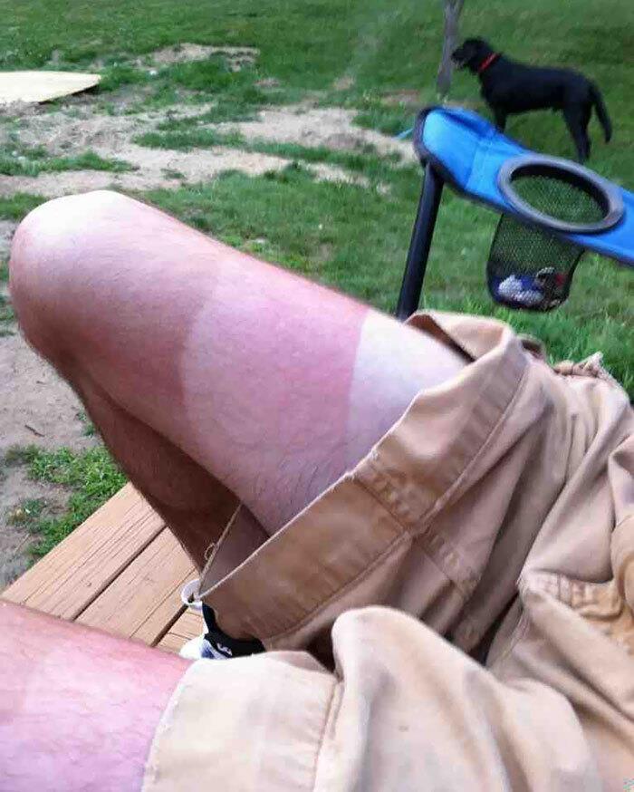 Chiến tích cháy nắng thê thảm khiến bạn muốn ruồng rẫy mùa hè-6