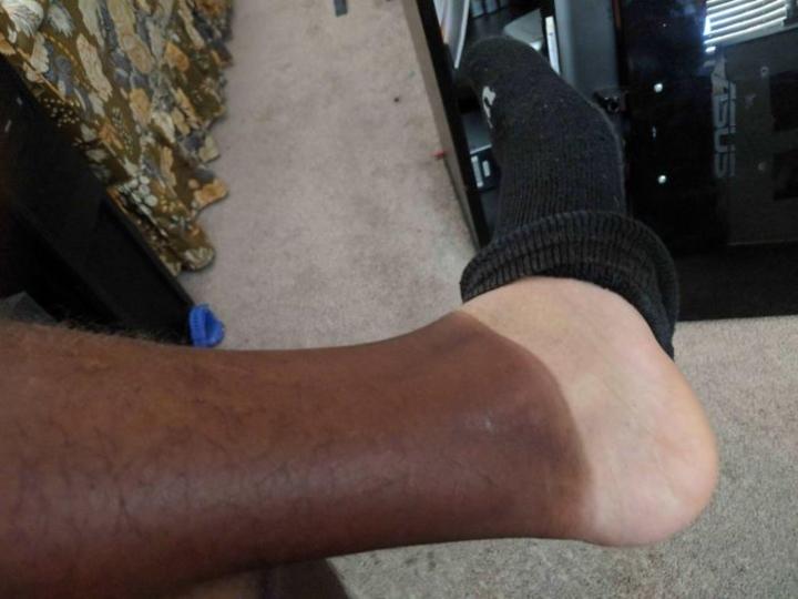 Chiến tích cháy nắng thê thảm khiến bạn muốn ruồng rẫy mùa hè-13