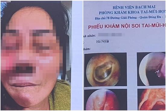 Hà Nội ghi nhận 3 ca hoại tử xương hàm