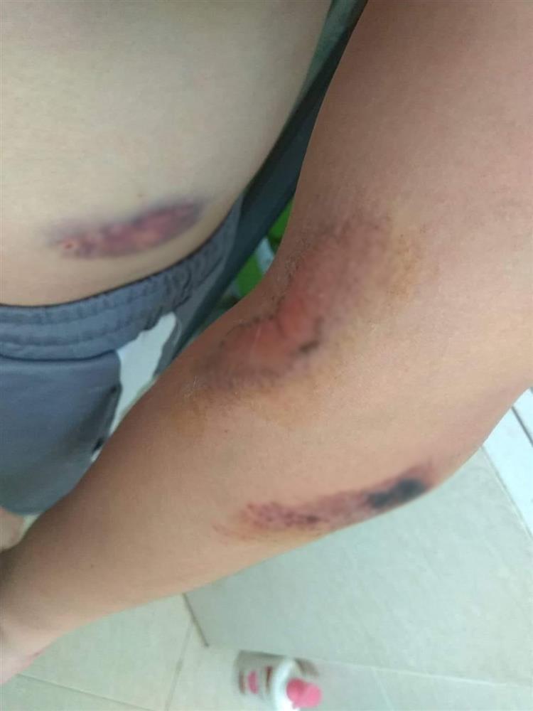 Đang lượn Hồ Tây, thanh niên suýt mất mạng vì bị dây diều siết cổ-2