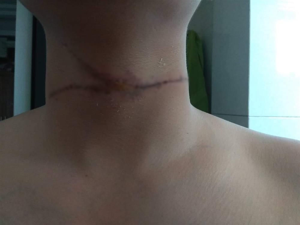 Đang lượn Hồ Tây, thanh niên suýt mất mạng vì bị dây diều siết cổ-3