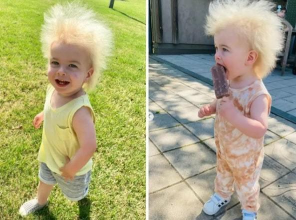 Mắc bệnh lạ, bé gái tóc bù xù giống hệt nhà khoa học Albert Einstein-1